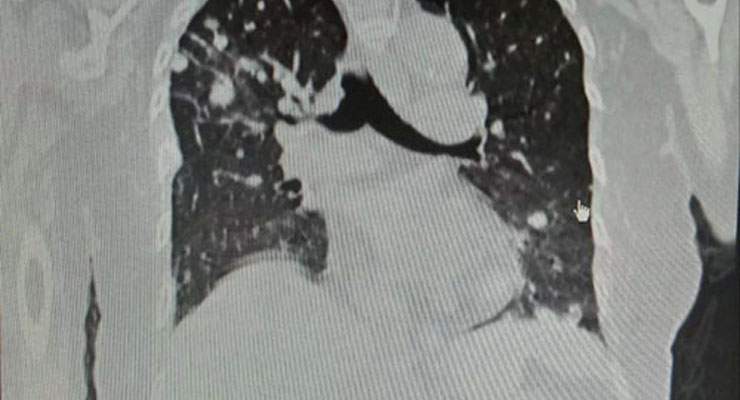 TCGA-CESC 子宫颈腺癌CT影像数据