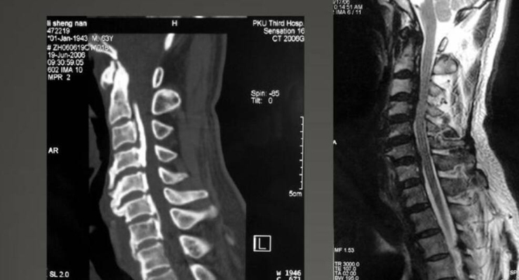 脊柱生物医学数据集
