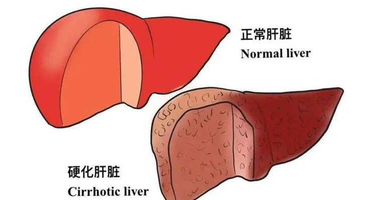丙型肝炎、纤维化、肝硬化数据集