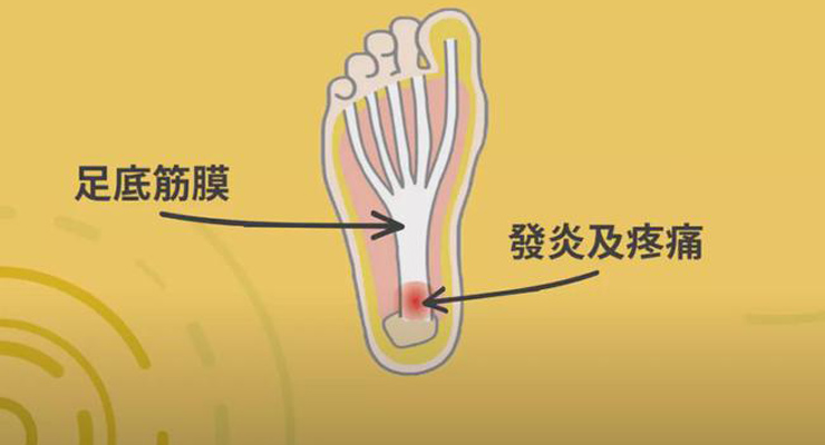 足底筋膜炎患者临床资料数据集