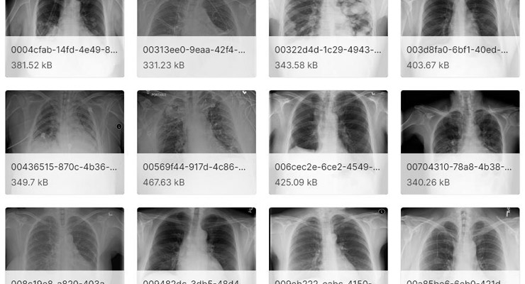 RSNA 肺炎图像检测挑战赛数据集