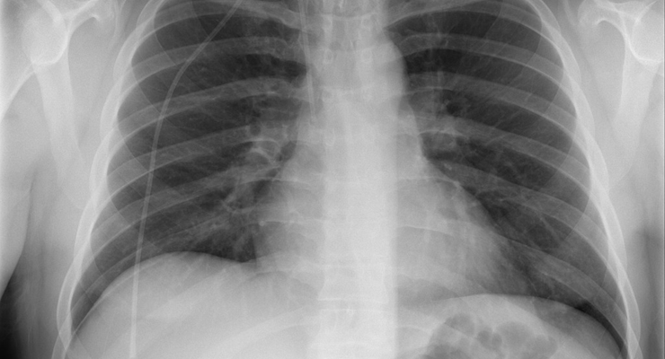 siim acr气胸分割数据集，完整数据集（DICOM + PNG + 标签）