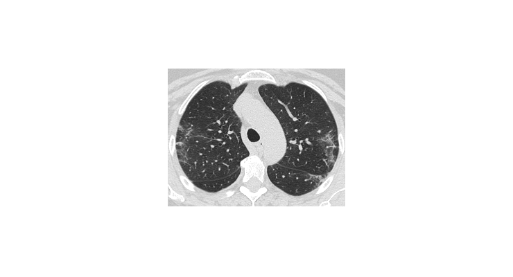 COVID19_Xray_Dataset