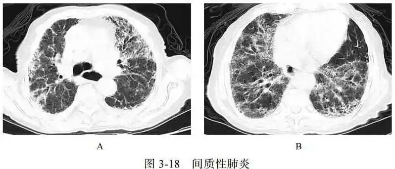 肺部CT分类数据集