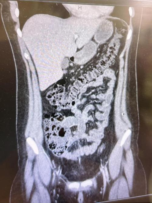 BTCV腹部CT数据集