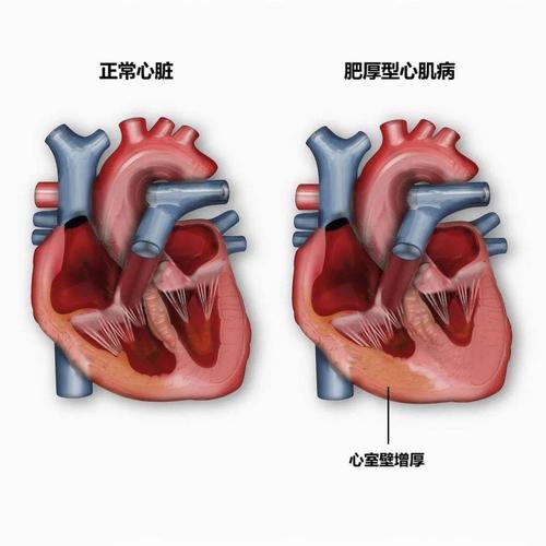 心脏病分类预测数据集