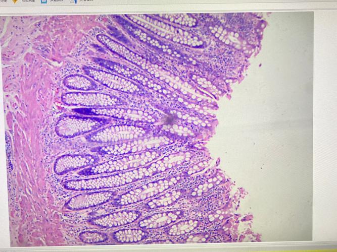 结直肠腺癌组织学图像数据集
