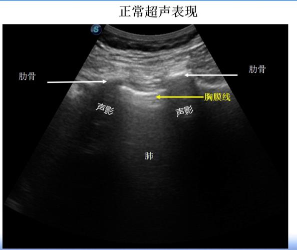 胎儿肺超声图像数据集