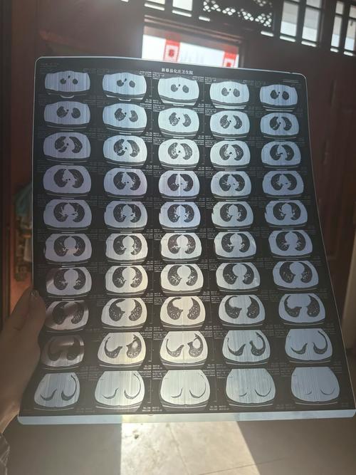 新冠肺炎CT数据集2
