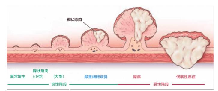 胃肠道疾病之息肉分割数据集