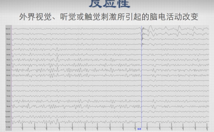 EEG and bis数据集