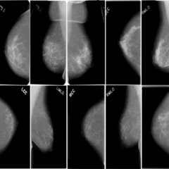 BCSC数字乳腺X线摄影数据集